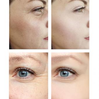 Revital Lifting Kollagen-Patches mit Hyaluron-Aktivator